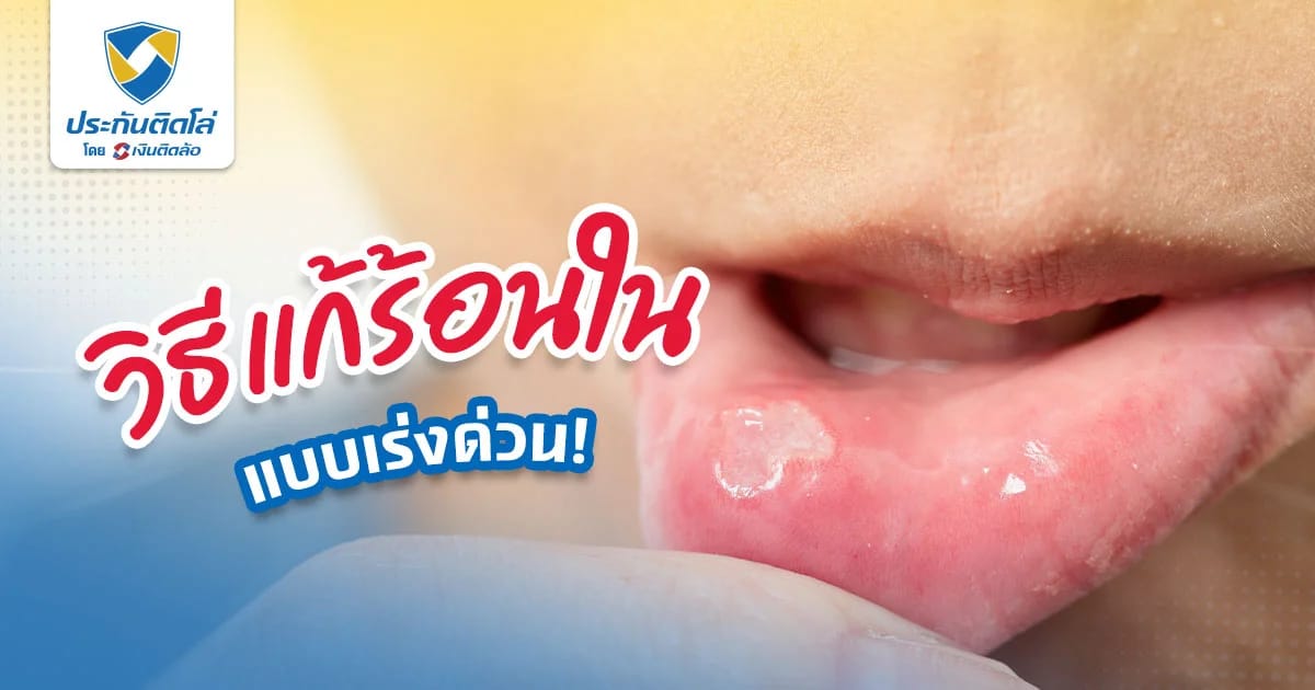 วิธีแก้ร้อนในเร่งด่วน เป็นร้อนในเกิดจากอะไร รู้ไว้ไม่เป็นอีก