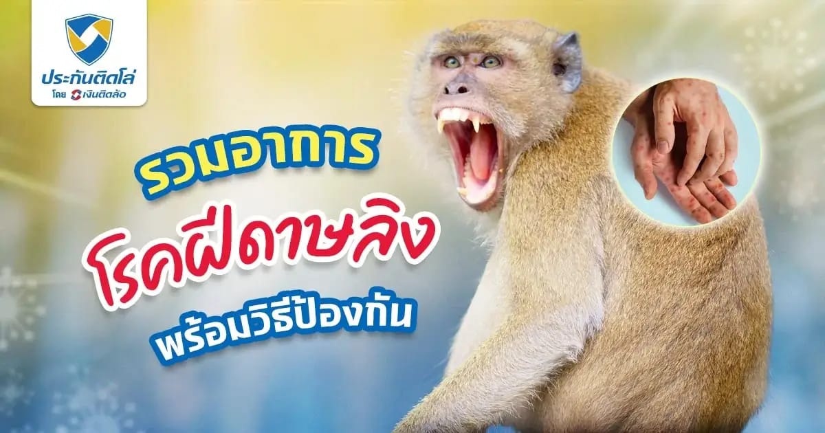 โรคฝีดาษลิงเกิดจากอะไร รวมอาการ เพื่อป้องกันไม่ให้เป็นโรคนี้