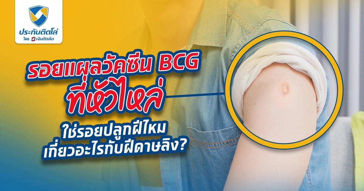 วัคซีน BCG ที่ฉีดทารกแรกเกิดคืออะไร ใช่รอยปลูกฝีหรือเปล่า?