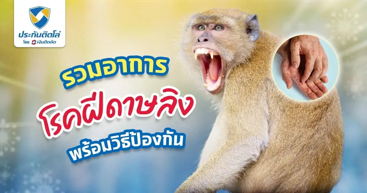 โรคฝีดาษลิงเกิดจากอะไร รวมอาการ เพื่อป้องกันไม่ให้เป็นโรคนี้